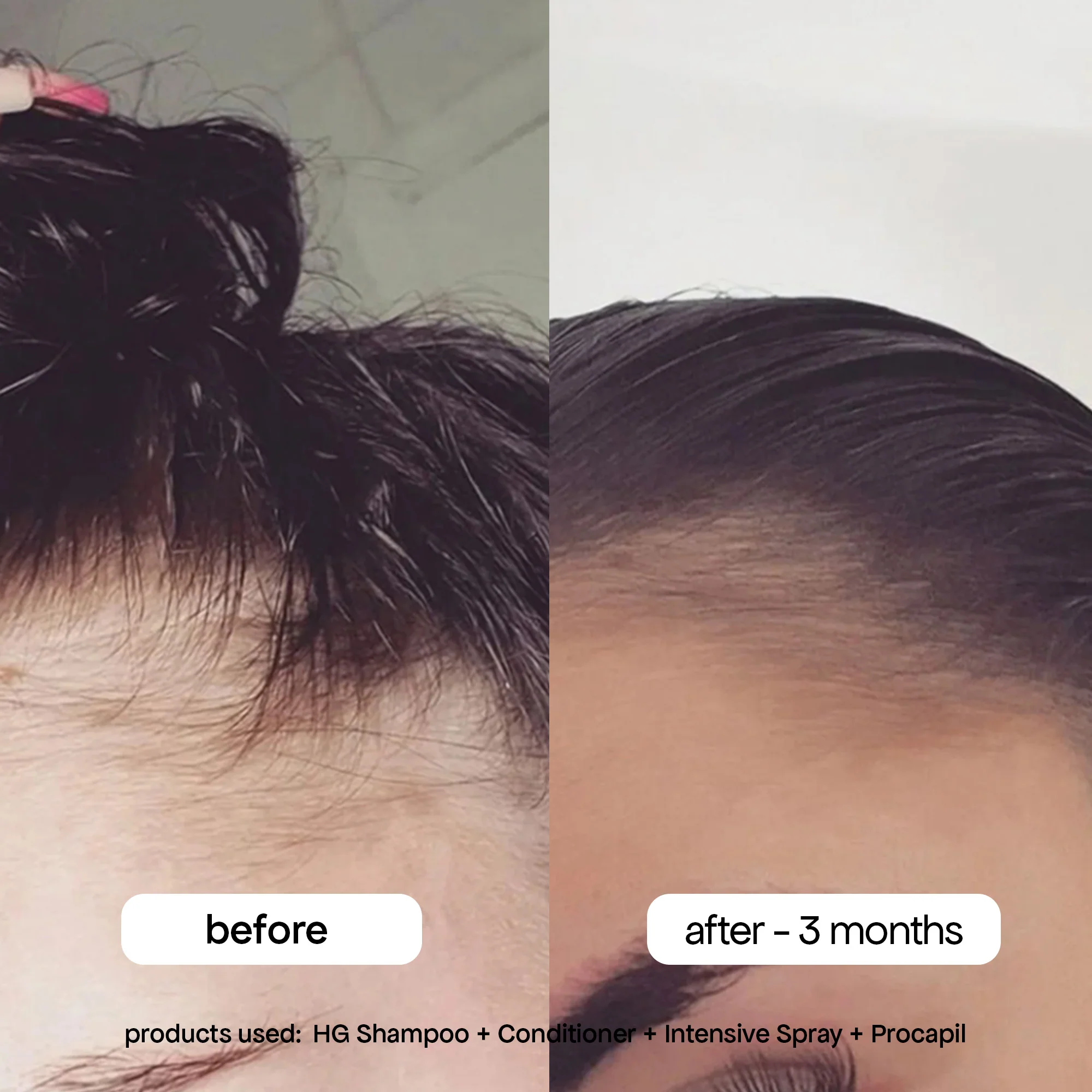 ANTI-THINNING PROCAPIL® SCALP TONIC - Image 3